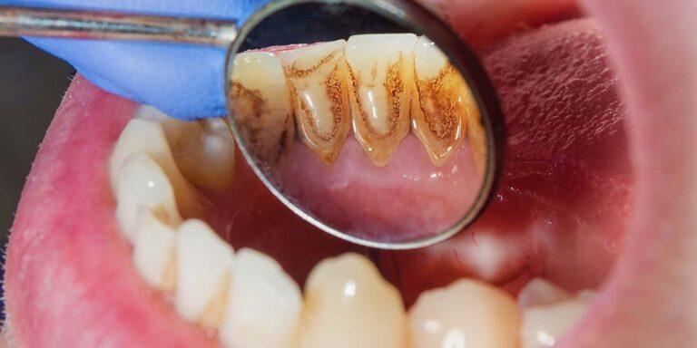 3 sinais de que você precisa consultar um dentista