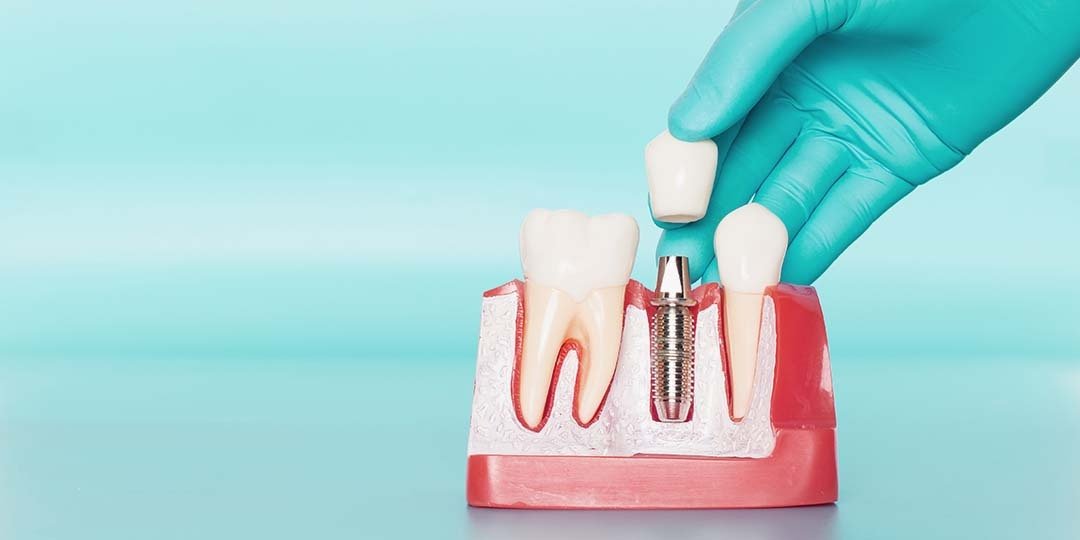 5 tipos de implantes dentários e como escolher o melhor para você