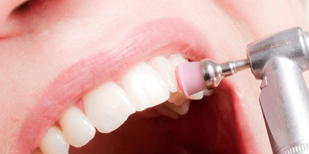 profilaxia-dental-o-que-e-e-como-e-feita