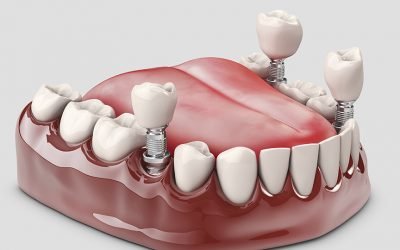 Implante de dente: como é feito, tipos e valores