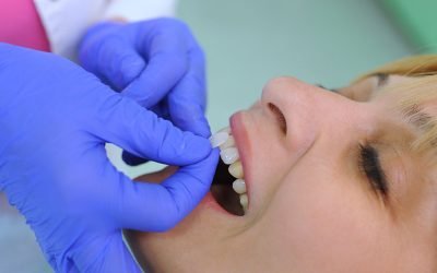 Facetas dentárias: o que são, tipos e para que servem