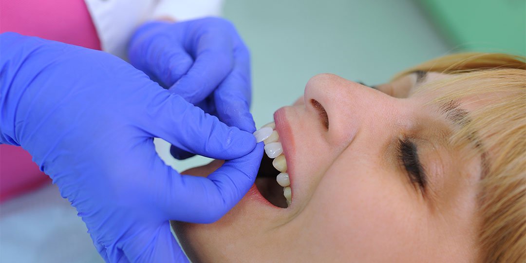 Facetas dentárias: o que são, tipos e para que servem