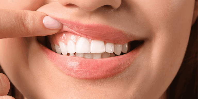 O sorriso gengival te incomoda? Saiba como corrigir o problema